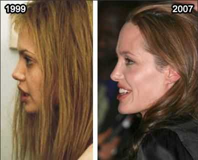 Джоли удалила молочные железы до и после фото
